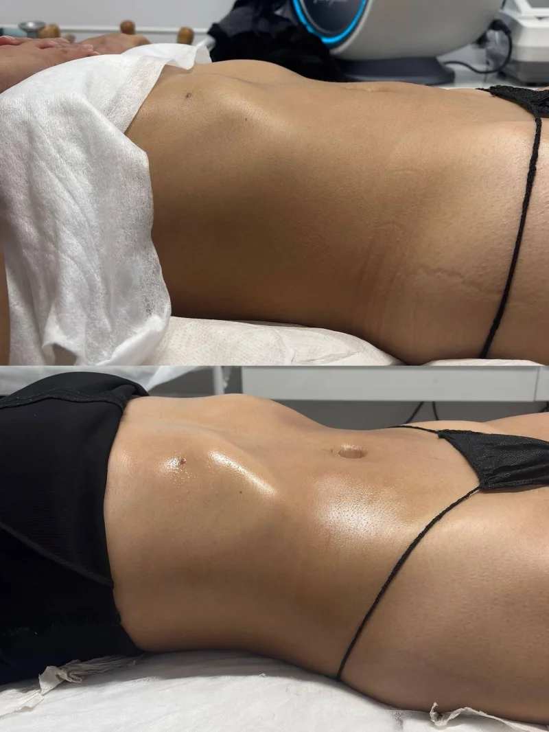 Tratamiento corporal — antes y después